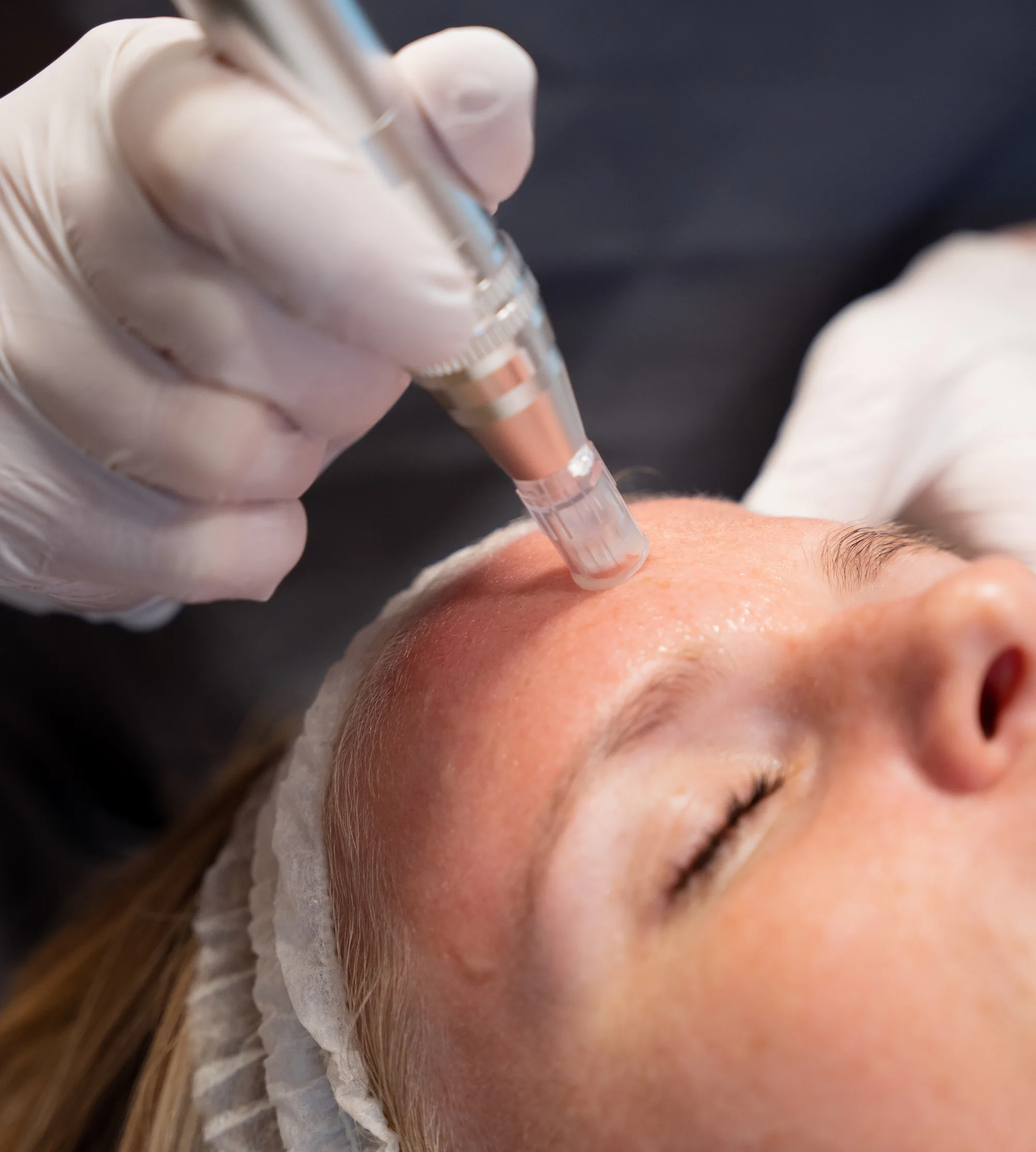Hva er microneedling?